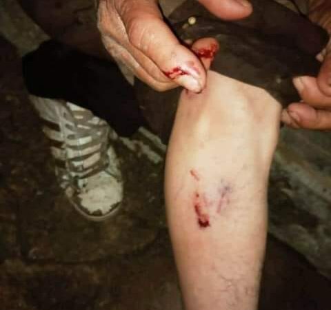 Tizimileño lo muerde un perro en la calle, le causa lesiones en la mano y pierna derecha