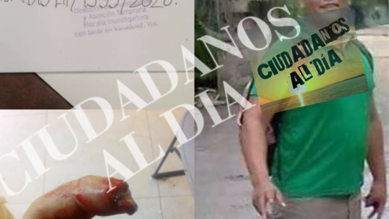 De una mordida le arrancó el dedo a una mujer en Valladolid, quedará libre