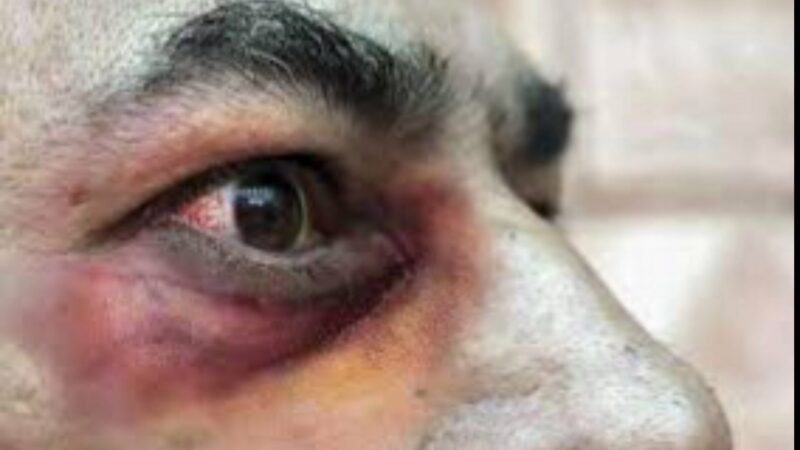 En Sinaloa cinco de ocho pacientes han muerto por hongo negro asociado al COVID-19