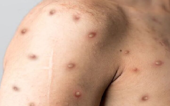 Emergencia sanitaria por un brote en 74 países de la viruela del mono: OMS