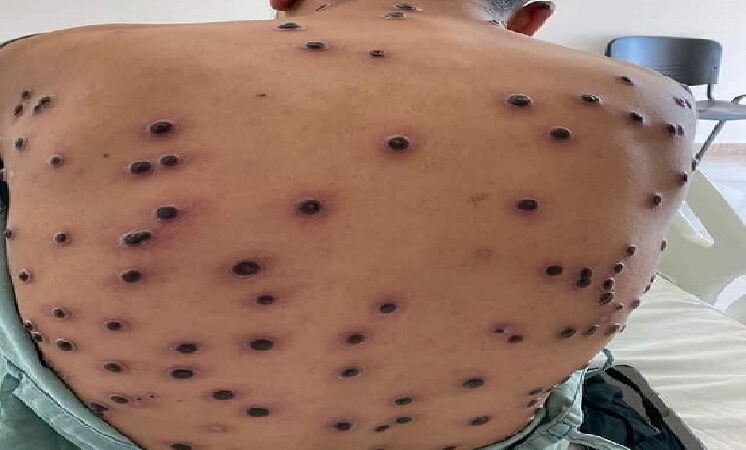 La viruela del mono cobró su primer muerto en Yucatán